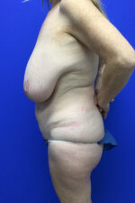 Reverse Tummy Tuck