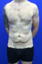 Tummy Tuck (men)