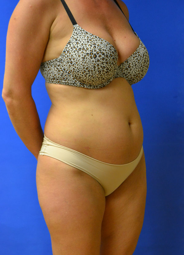 Breast Liposuction in St Louis